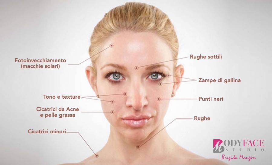 Benefici%20del%20microneedling.JPG