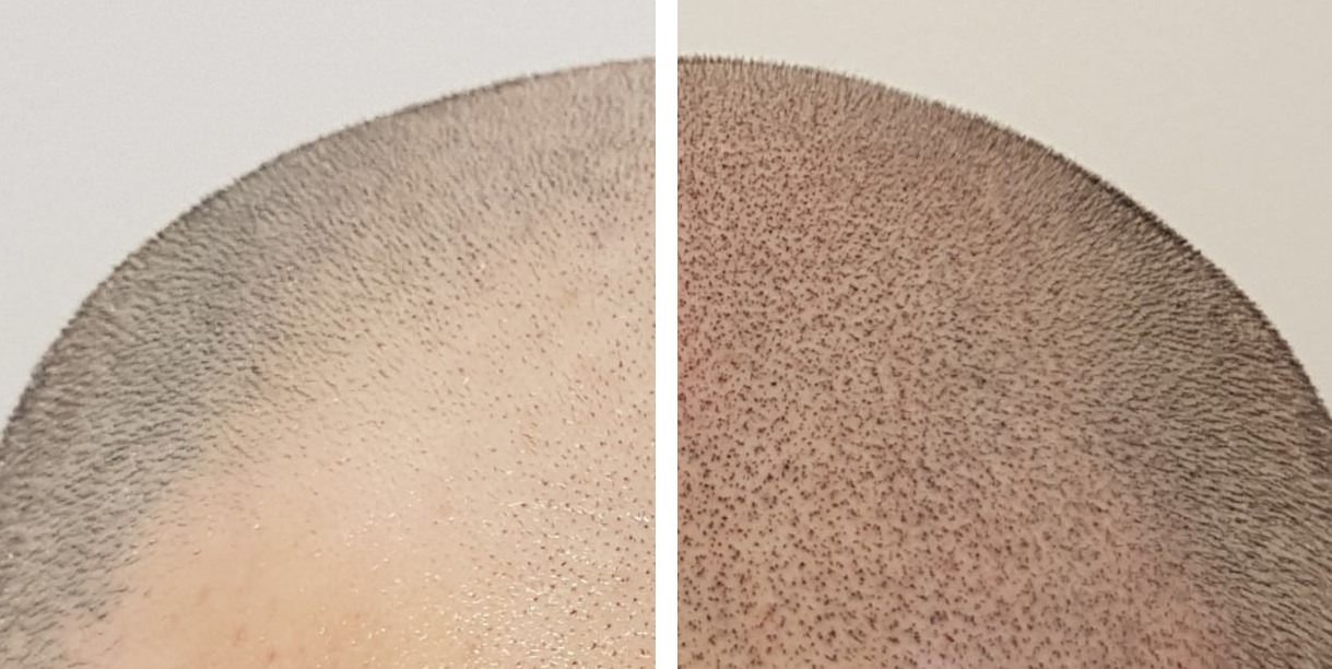 Tricopigmentazione%20menu