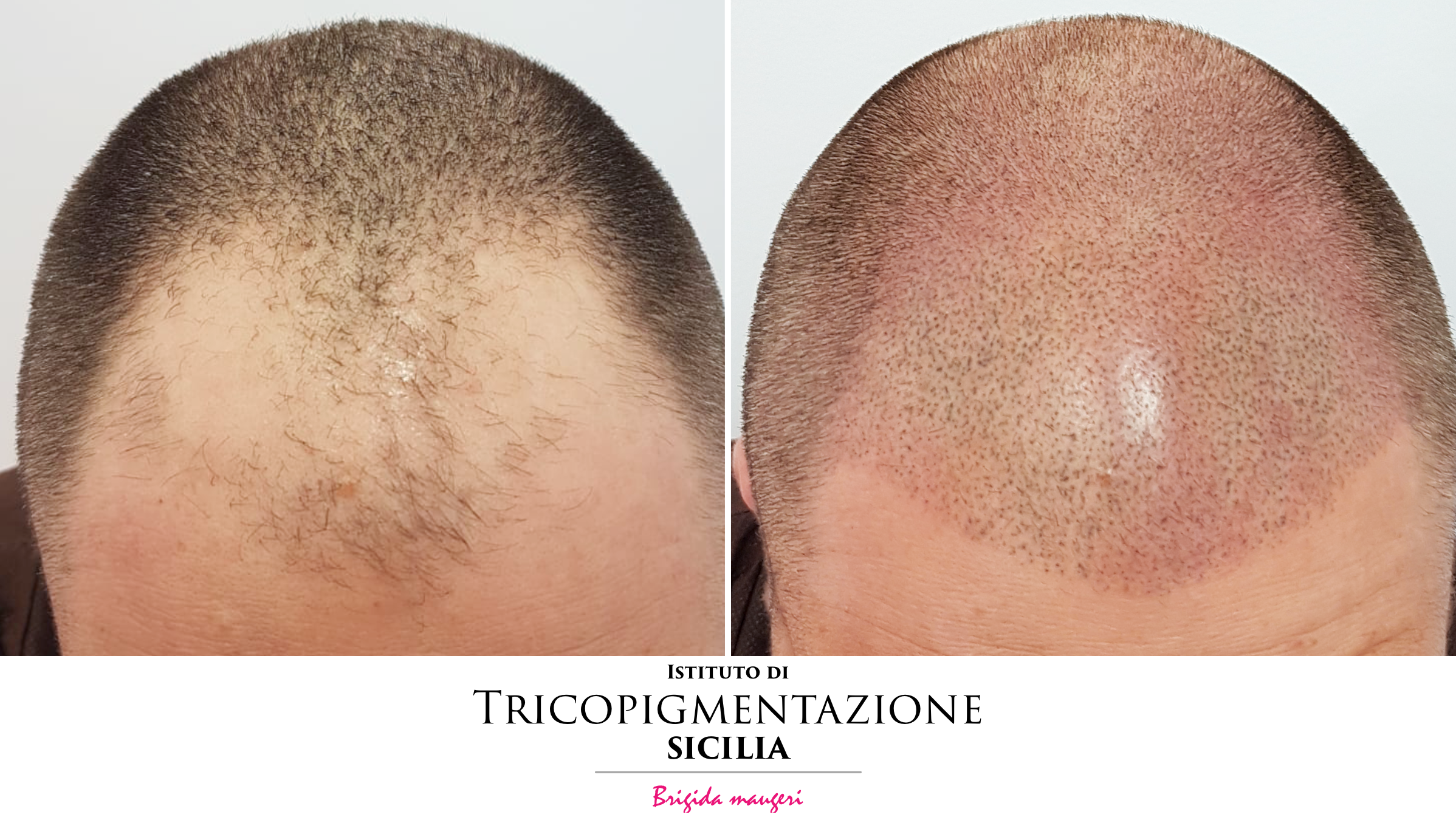 Post%20Tricopigmentazione%20178%20DX