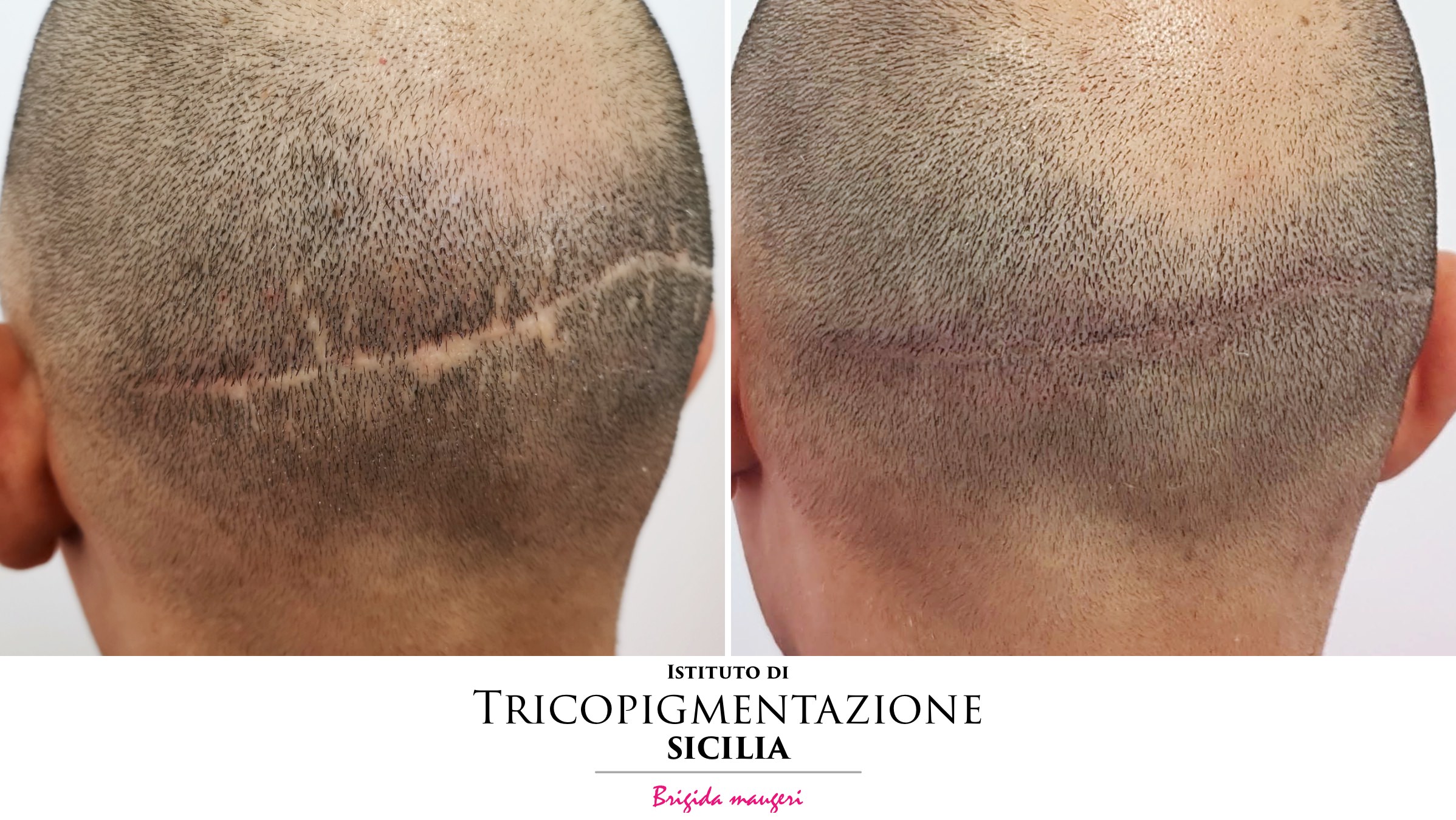 Post%20Tricopigmentatore%20178%20DX