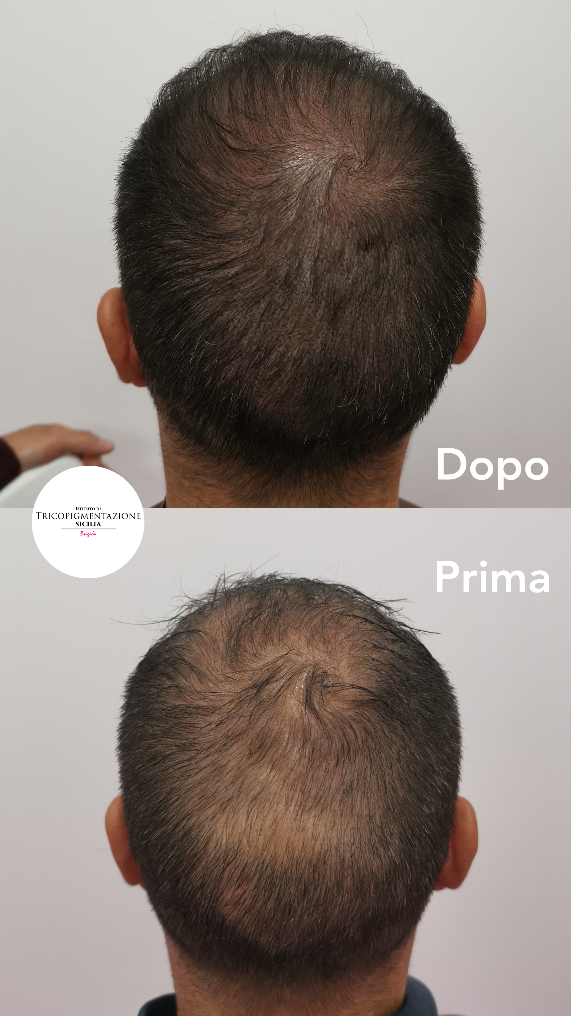 Post%20Tricopigmentazione%20178%20DX