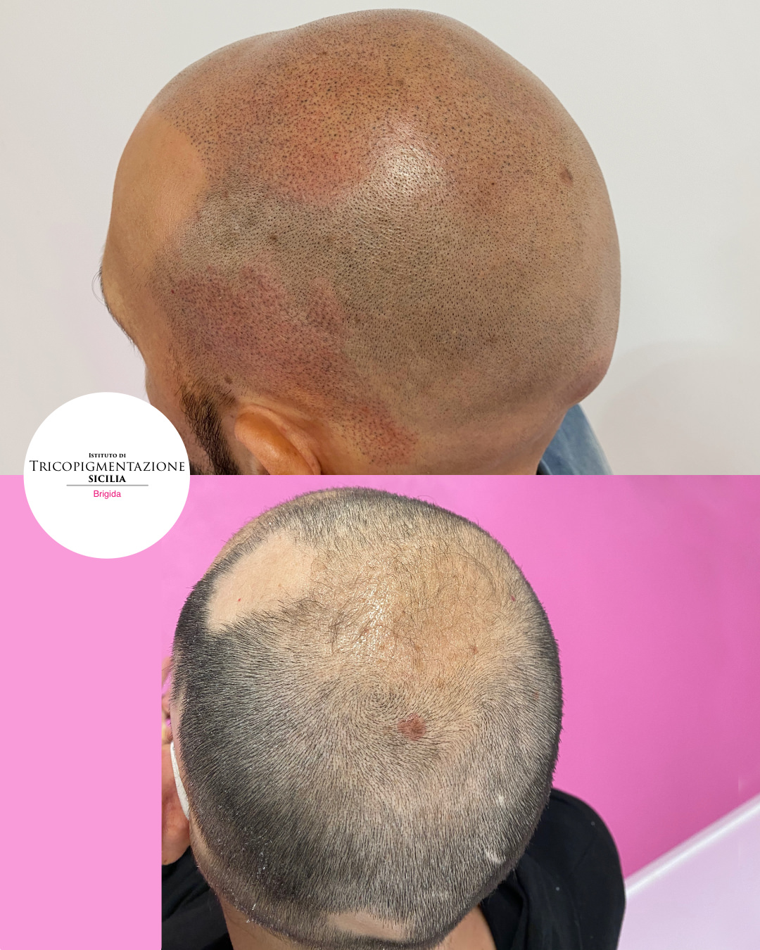 Post%20Tricopigmentatore%20178%20DX