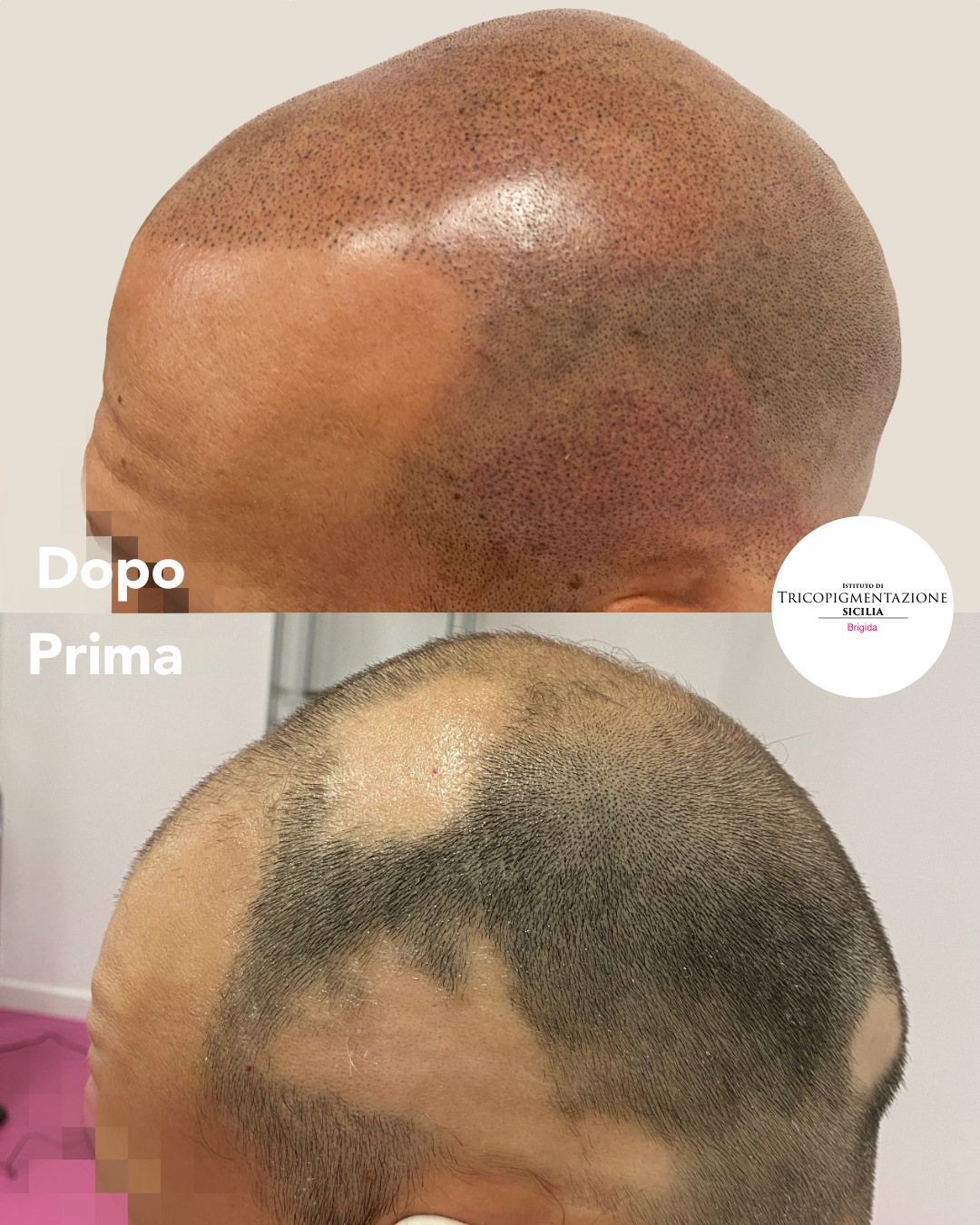 Post%20truccopermanentecalvizie%20178%20DX