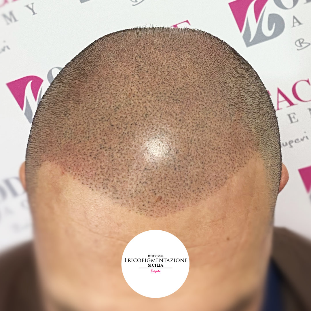 Post%20Tricopigmentazione%20178%20DX