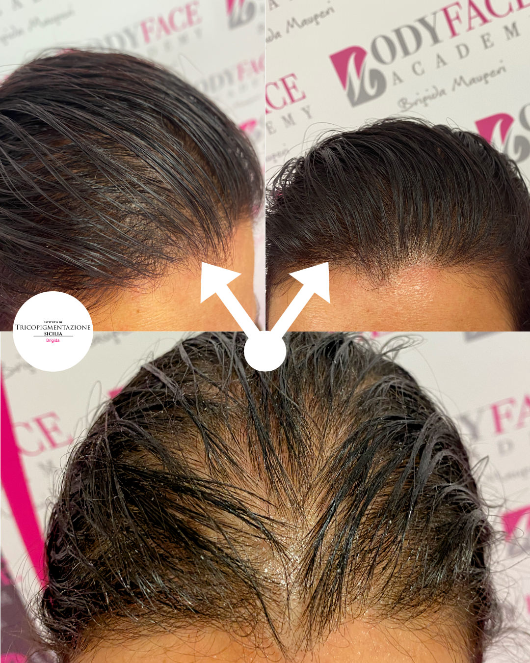 Post%20Tricopigmentatore%20178%20DX