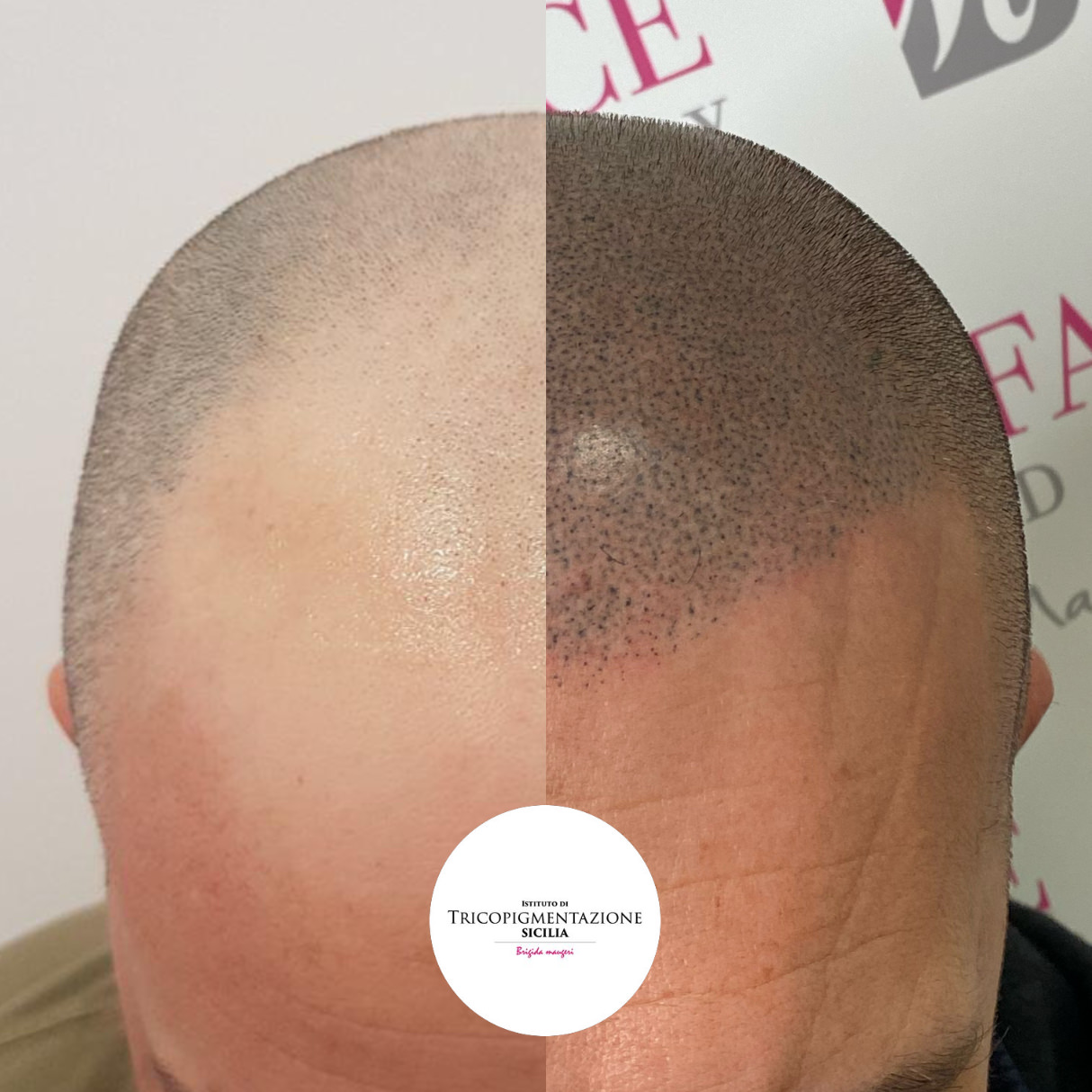 Migliore tricopigmentazione