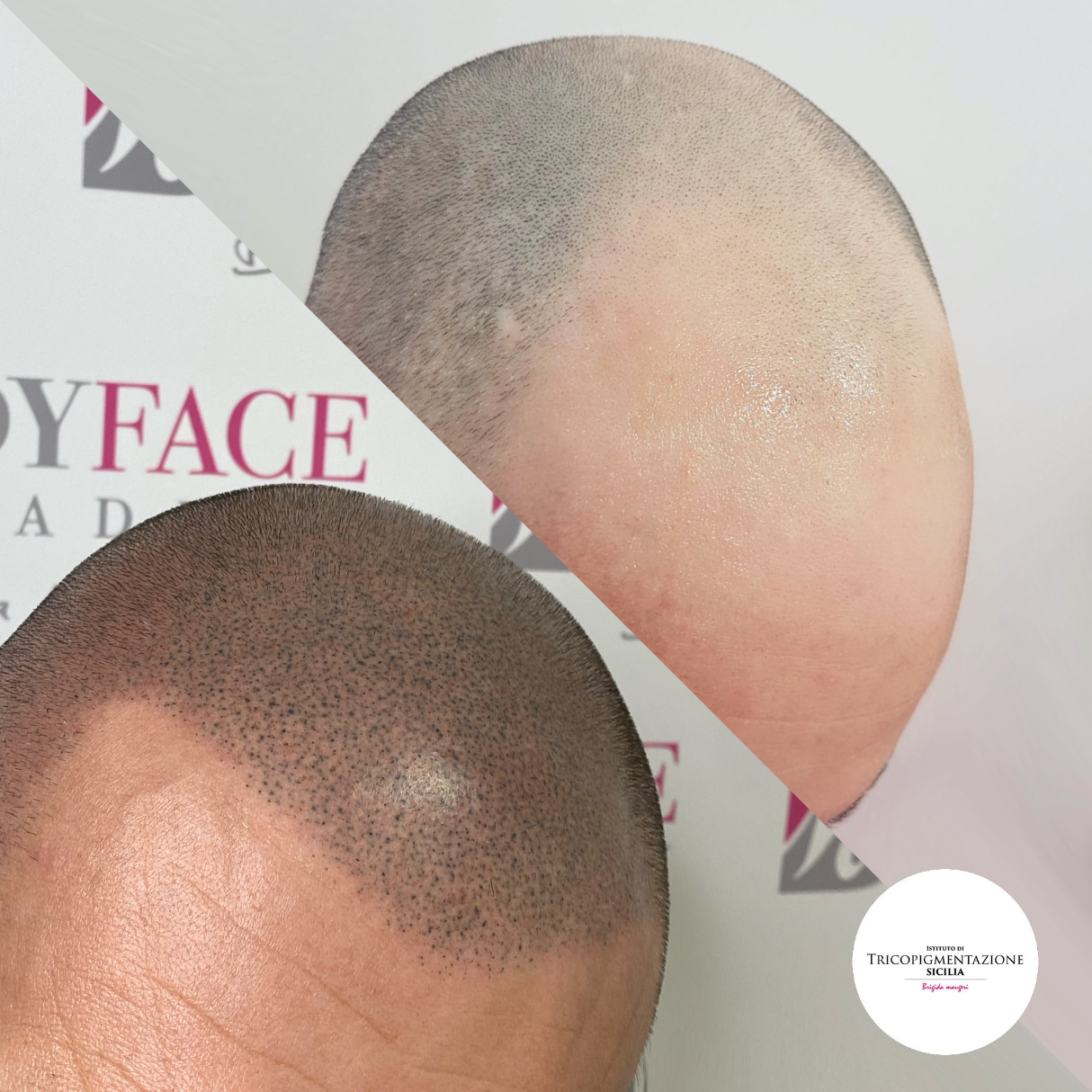 Migliore tricopigmentazione