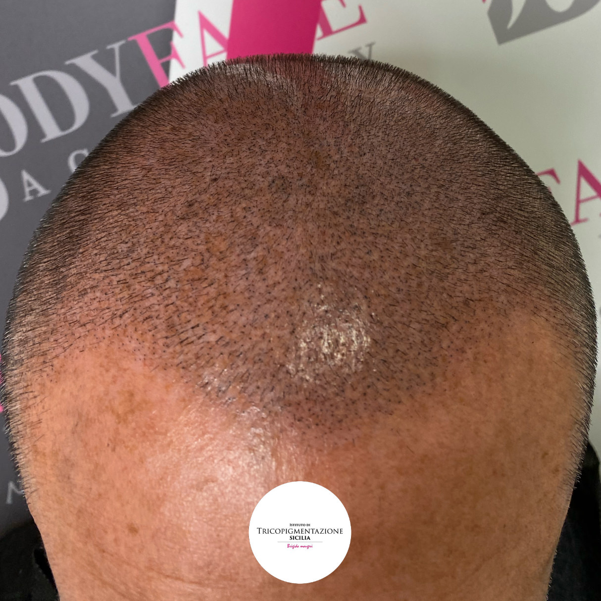 Migliore tricopigmentazione