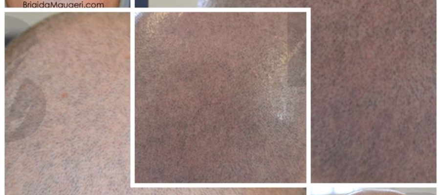 Blog%20tricopigmentazione