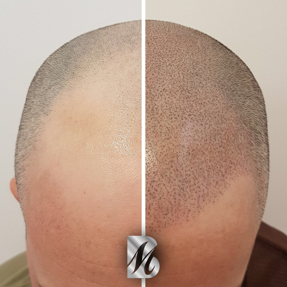 Post%20Tricopigmentazione%2011