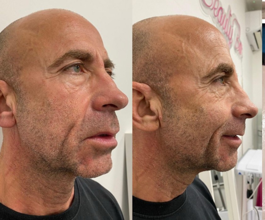 Mesosomi con MesoBoost di Brigida Maugeri