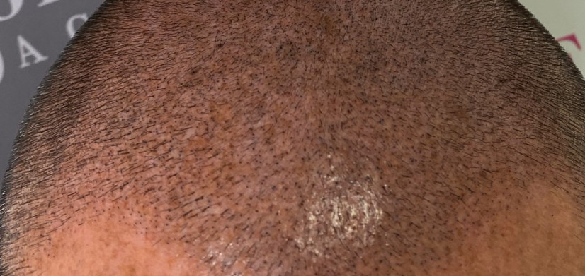 Tricopigmentazione permanente: Il rischio di risultati non desiderati