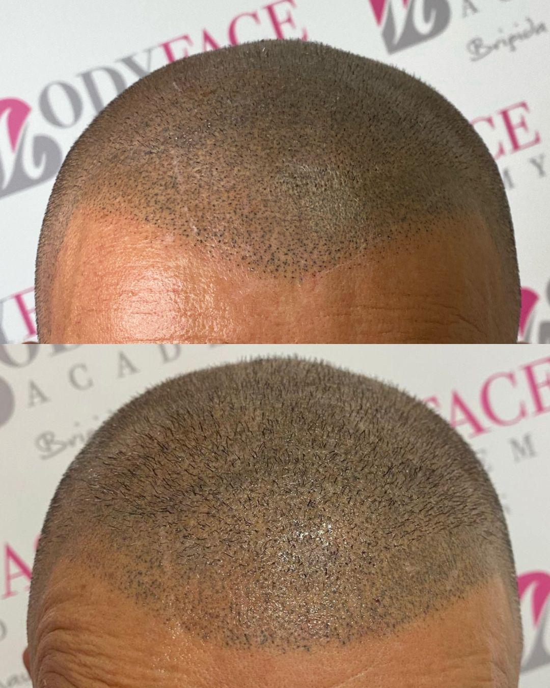 tricopigmentazione_naturale